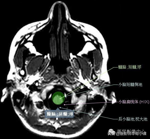 颅脑mri(头部MRI)插图(41)