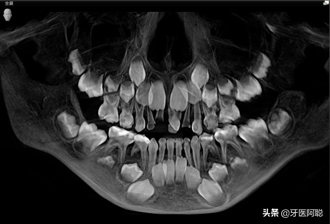 上门牙多生牙图片(多生牙的治疗最佳治疗方法)插图