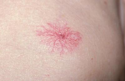 脸上长血痣是什么原因,突然长了好几个红痣-相术-荣耀易学