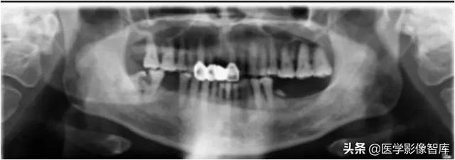 颞间隙感染，颞间隙感染切开部位（颌面部间隙感染影像诊断及各间隙解剖介绍）