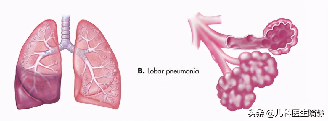 小儿支气管肺炎怎么引起的(小儿支气管肺炎如何治疗)
