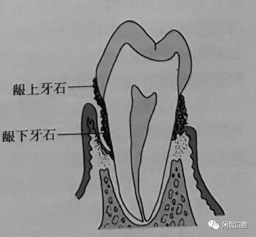 牙菌斑是什么，口腔白斑是什么病严重吗（牙菌斑和牙石）