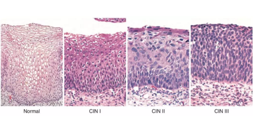 cin1级是什么意思(活检cin1级hpv阳性)插图(2)