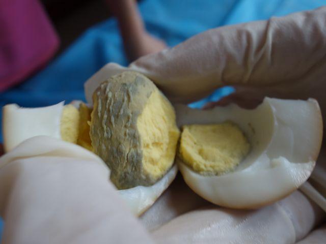 滚煮鸡蛋驱寒,煮鸡蛋滚脖子可以驱寒吗(家喻户晓的"滚蛋疗法"真的能