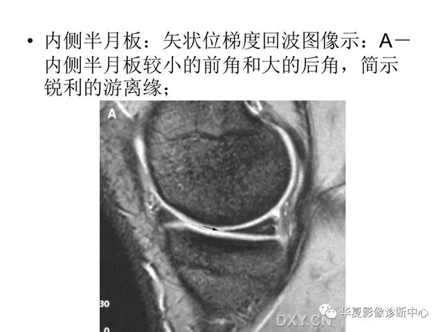 膝关节解剖结构图，膝盖解剖图示意图（膝关节MRI之正常解剖综述）