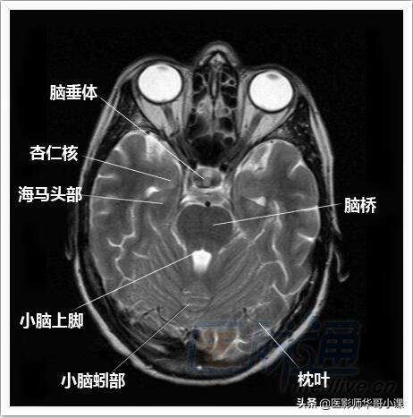 颅脑mri(头部MRI)插图(4)