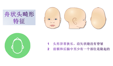 婴儿舟状头的图片，宝宝多大可以排除舟状头（婴幼儿头颅畸形）