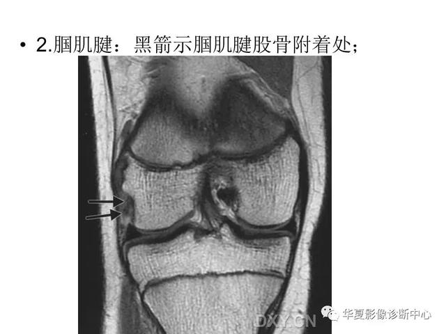 膝关节解剖结构图，膝盖解剖图示意图（膝关节MRI之正常解剖综述）