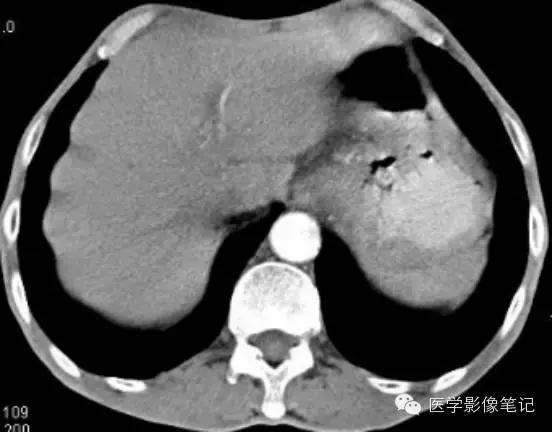 吃赖尿虾的好处，孕妇可以吃濑尿虾吗中期（这8种肝脏变异）