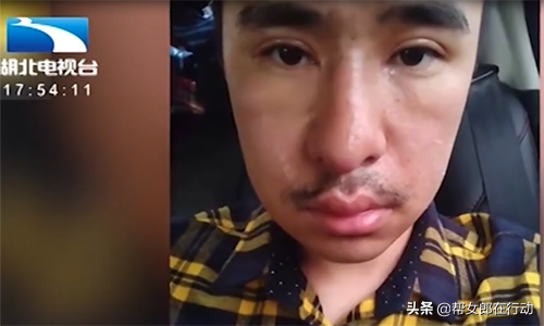 鼻部整容多少钱，整鼻多少钱（小伙花4万整容成鼻畸形）