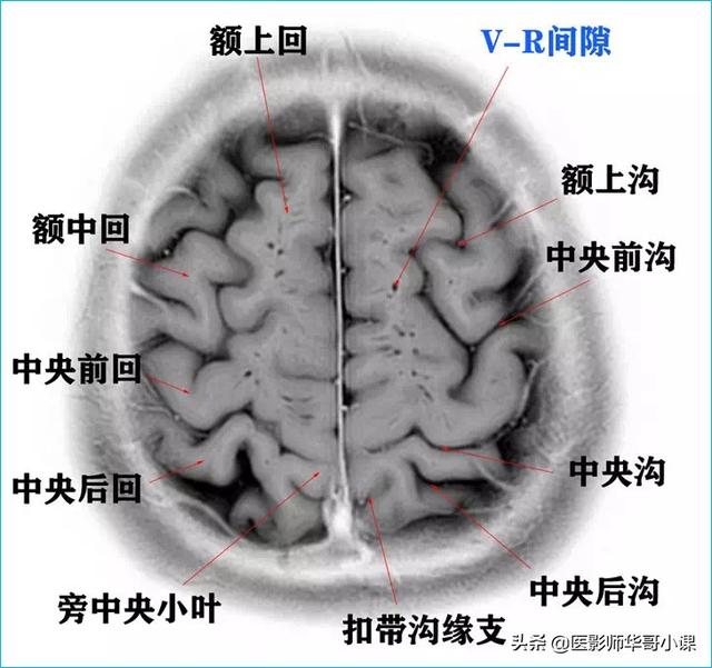 头颅ct解剖图，头部骨骼结构图（颅脑磁共振MRI解剖结构以及高清图谱）