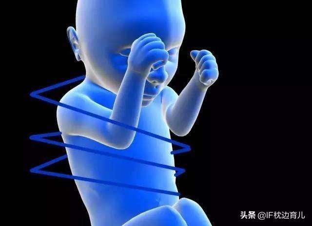 胎儿脐带绕颈一周可以顺产吗，脐带绕颈一周能不能顺产（胎儿脐带绕颈一周严重吗）