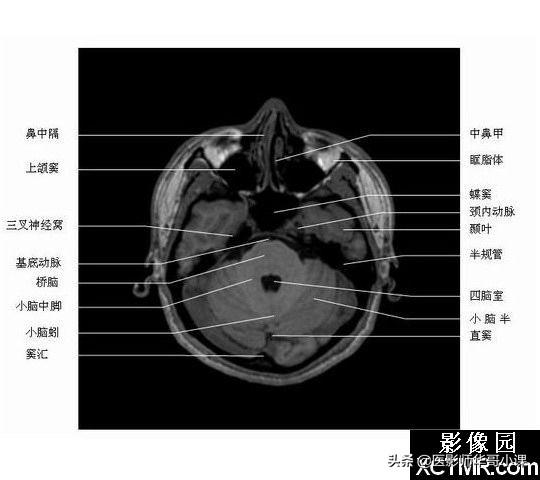 颅脑mri(头部MRI)插图(50)