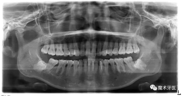 为什么牙医建议尽量不拔智齿，牙齿烂了一个洞很痛怎么办（作为牙医我坦诚爆料）