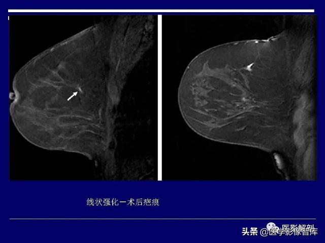 乳房解剖学基础知识，乳腺解剖及乳腺各病变影像诊断与鉴别