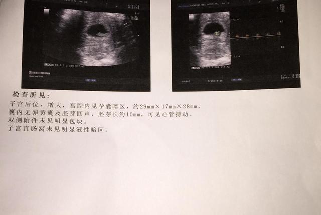 怀孕30天B超孕囊图，怀孕多久能查出孕囊（B超单上孕囊数据暗藏玄机）