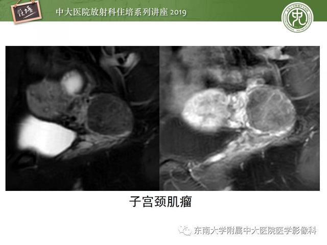 子宫颈影像解剖，子宫详细解剖及磁共振信号分析