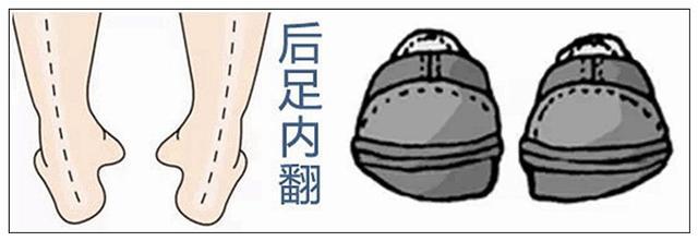 警惕宝宝足外翻，小孩子足外翻（足内翻或足外翻到底是什么）