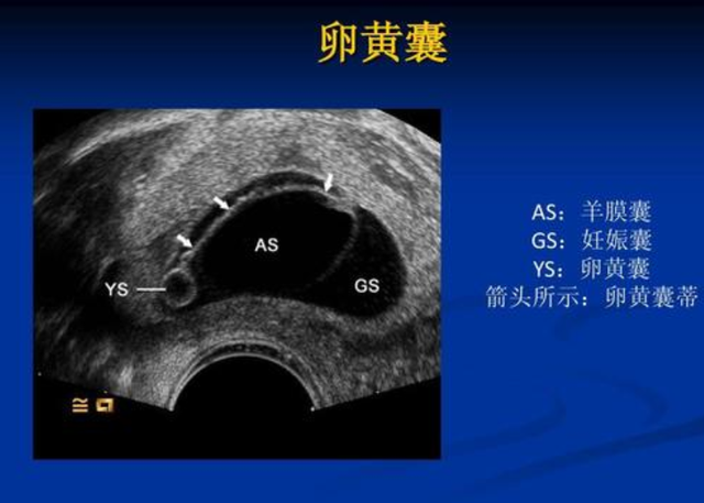 大夫说有卵黄囊胎儿就很好，内见卵黄囊未见胚芽是什么意思（孕早期B超单据四个数据）