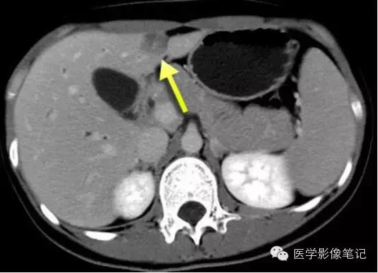 吃赖尿虾的好处，孕妇可以吃濑尿虾吗中期（这8种肝脏变异）