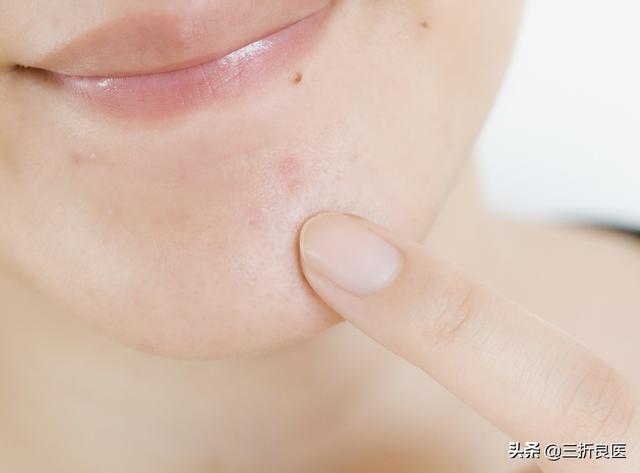 痘印痘坑如何修复，脸上的痘坑痘印如何修复（针对痘印、痘疤相关建议）