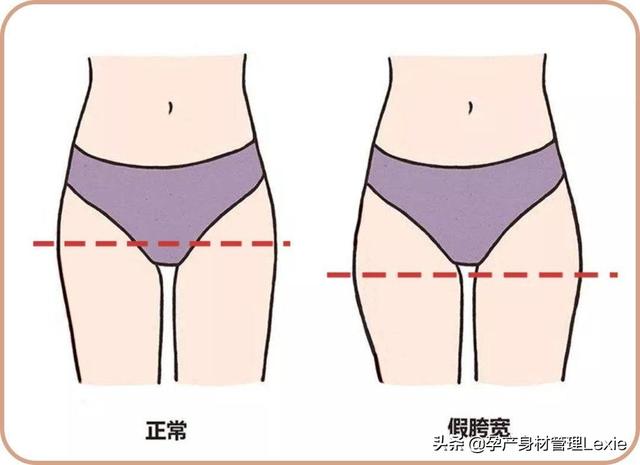 生完孩子假胯宽怎么办，生孩子后假胯宽怎么矫正（都是“假胯宽”惹的祸）