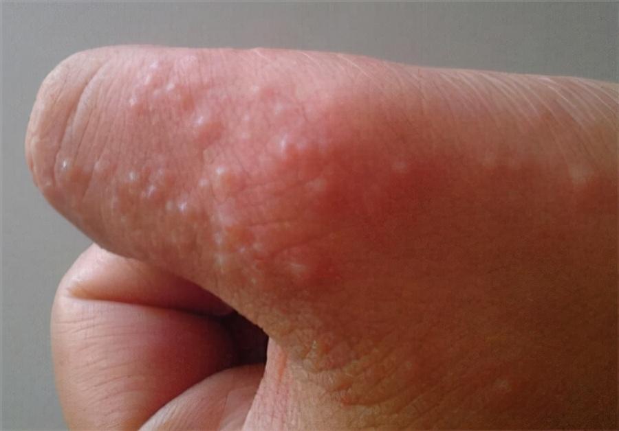 经过看诊之后,发现大多都是汗疱疹患者