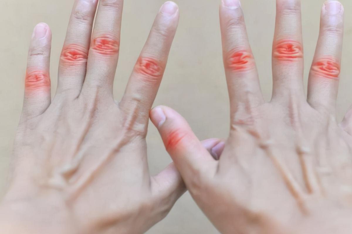 早上起来手指肿是怎么回事(早上起来手指僵硬弯曲有疼痛感) - 珍缘