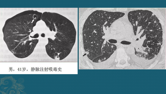 碘酒过期了还能用吗，过期了的碘酒还能不能用（硬扛3天不吃抗生素必后悔）