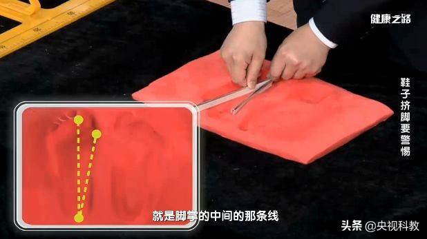 小拇指外翻怎么矫正，让你又丑又疼的拇外翻矫正方法在这里