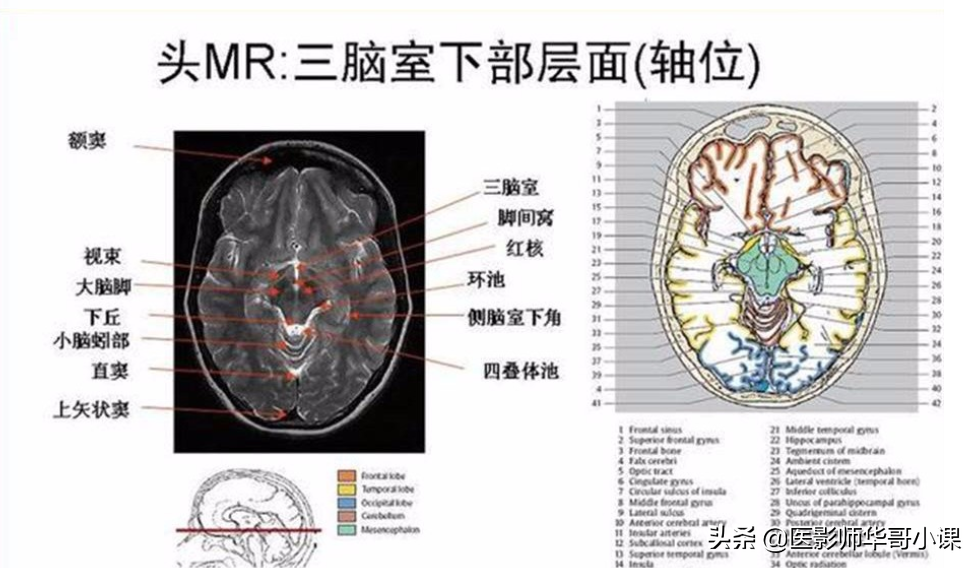 颅脑mri(头部MRI)插图(74)