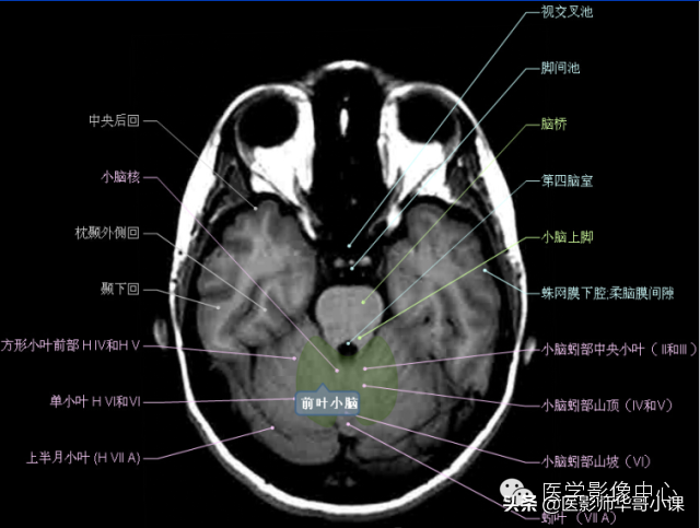 颅脑mri(头部MRI)插图(35)