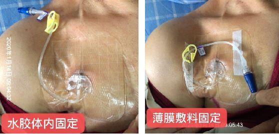 接口处充不进电弯着才充进电，充电 接口 插不进（输液港抽不出回血怎么办）