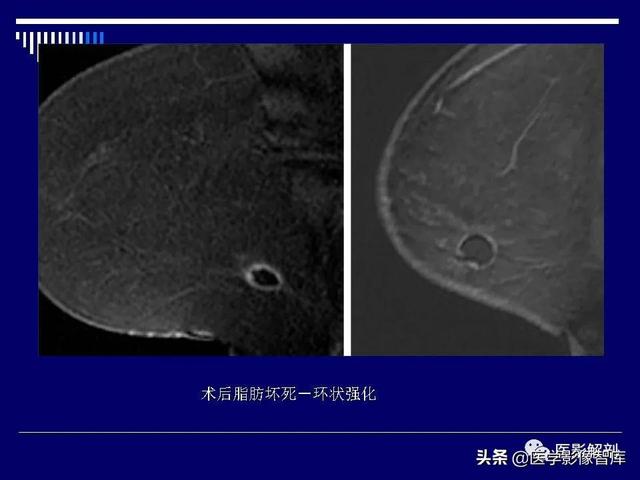 乳房解剖学基础知识，乳腺解剖及乳腺各病变影像诊断与鉴别