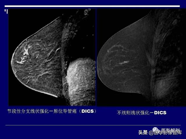 乳房解剖学基础知识，乳腺解剖及乳腺各病变影像诊断与鉴别