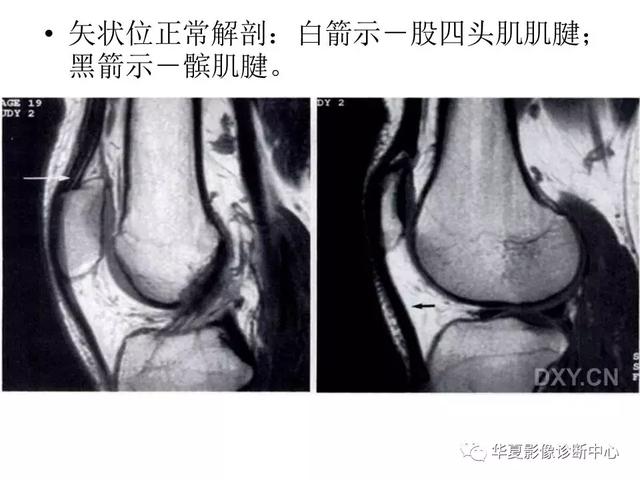 膝关节解剖结构图，膝盖解剖图示意图（膝关节MRI之正常解剖综述）