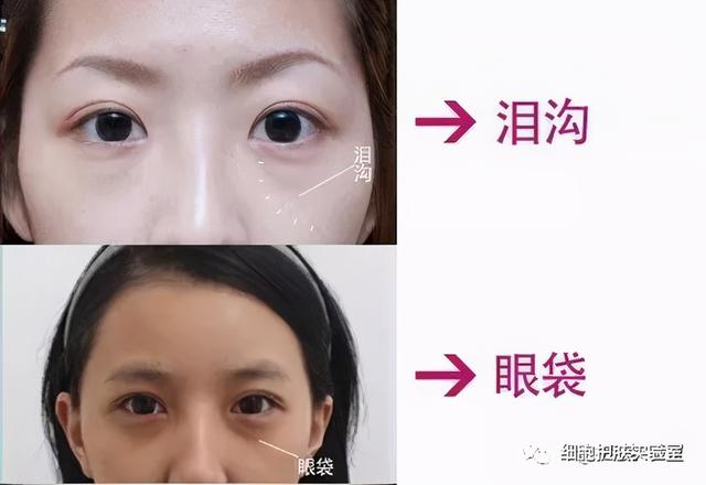 泥奏凯是什么意思，皱纹小百科-泪沟，泥奏凯