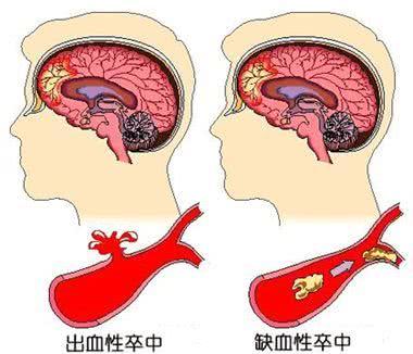 词语卒中的读音，卒中的读音（你可能一样都没搞清楚）