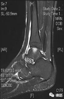 崴脚不拍片怎样判断是否骨折，崴脚怎么判断骨头没事（浅谈“崴脚”你不知道的那点事）