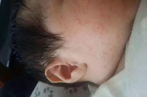 婴儿痱子粉(宝宝长痱子用爽身粉竟是错的) - 乐宝宝贝