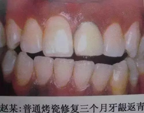 烤瓷牙是怎么做的，烤瓷牙是怎么做的伤牙吗（牙医教你如何选择烤瓷牙的材料）