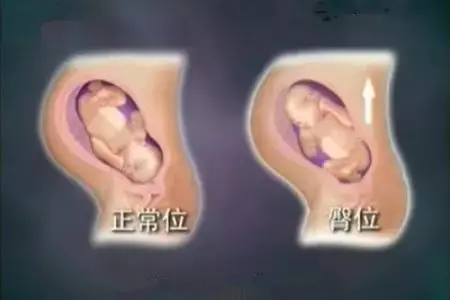 29周臀位还能转回来吗，孕29周臀位需要纠正吗（孕期臀位怎么办）