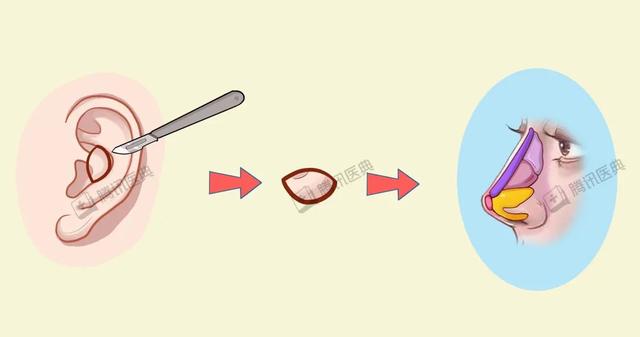 关于隆鼻的五个小常识，千万要注意避免这5个坑