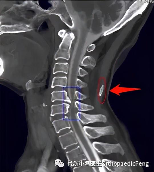 后纵韧带解剖图，颈椎的韧带有哪些