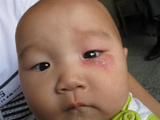 隐翅虫在床上爬了还能睡吗，家里为什么会有隐翅虫（妈妈用3分钟处理法救了娃）