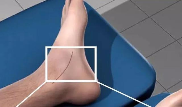 足舟骨突出图片,足舟骨突出疼痛怎么办(你怎么比别人多了一块骨头) 足舟骨突出图片,足舟骨突出疼痛怎么办(你怎么比别人多了一块骨头)