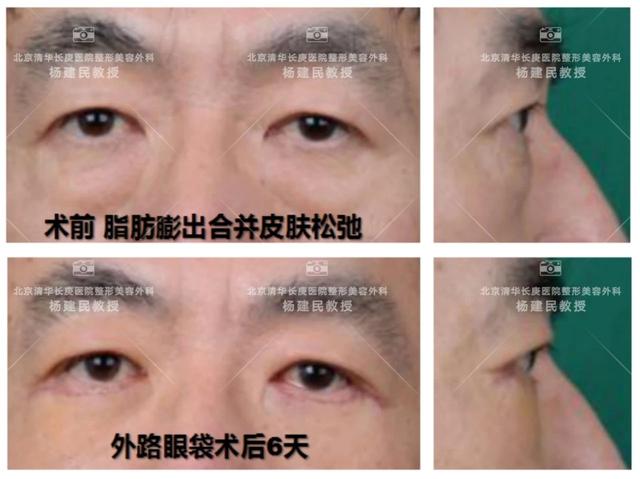 大眼袋怎么消除，大眼袋怎么消除（整形医生教您如何去除“大眼袋”）