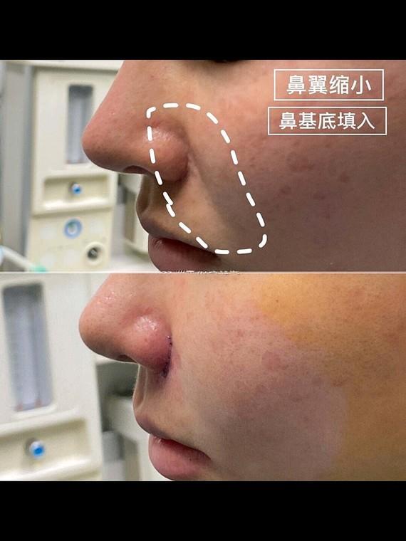 鼻基底填充原理，鼻基底填充的效果（注射填充好还是假体填充好）