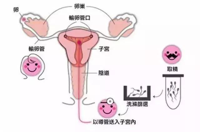 人工受孕是怎么做，人工受孕怎么做（我们聊聊人工授精...）