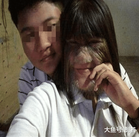 脸上长毛怎么办，用了烟酰胺脸上长毛怎么办（女孩身患“怪病”脸上长毛）